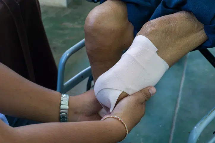 a nurse bandaging an amputated knee